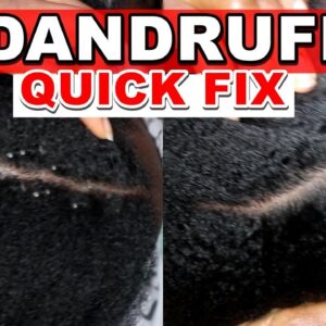 Dandruff Flakes Removal and Dandruff Treatment